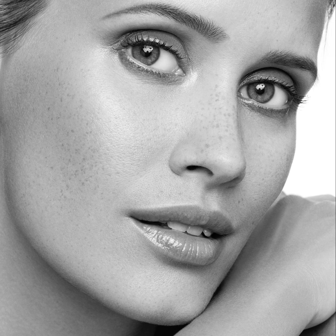 Ošetření Dermosomem problematická pleť se sklony k akné