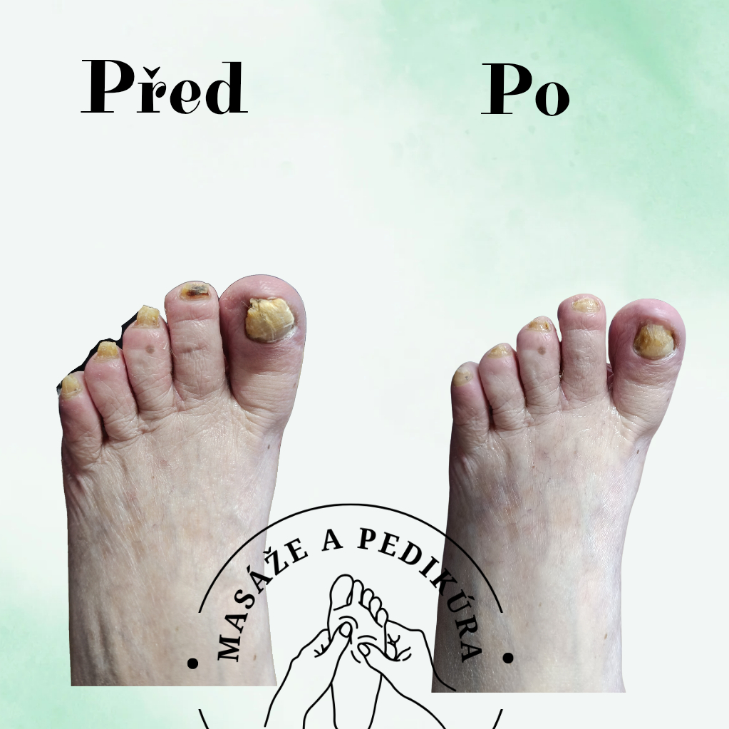 pedikúra