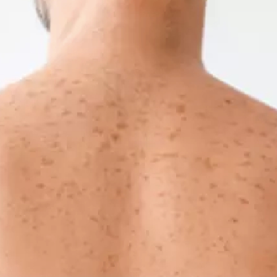 IPL odstranění pigmentace záda