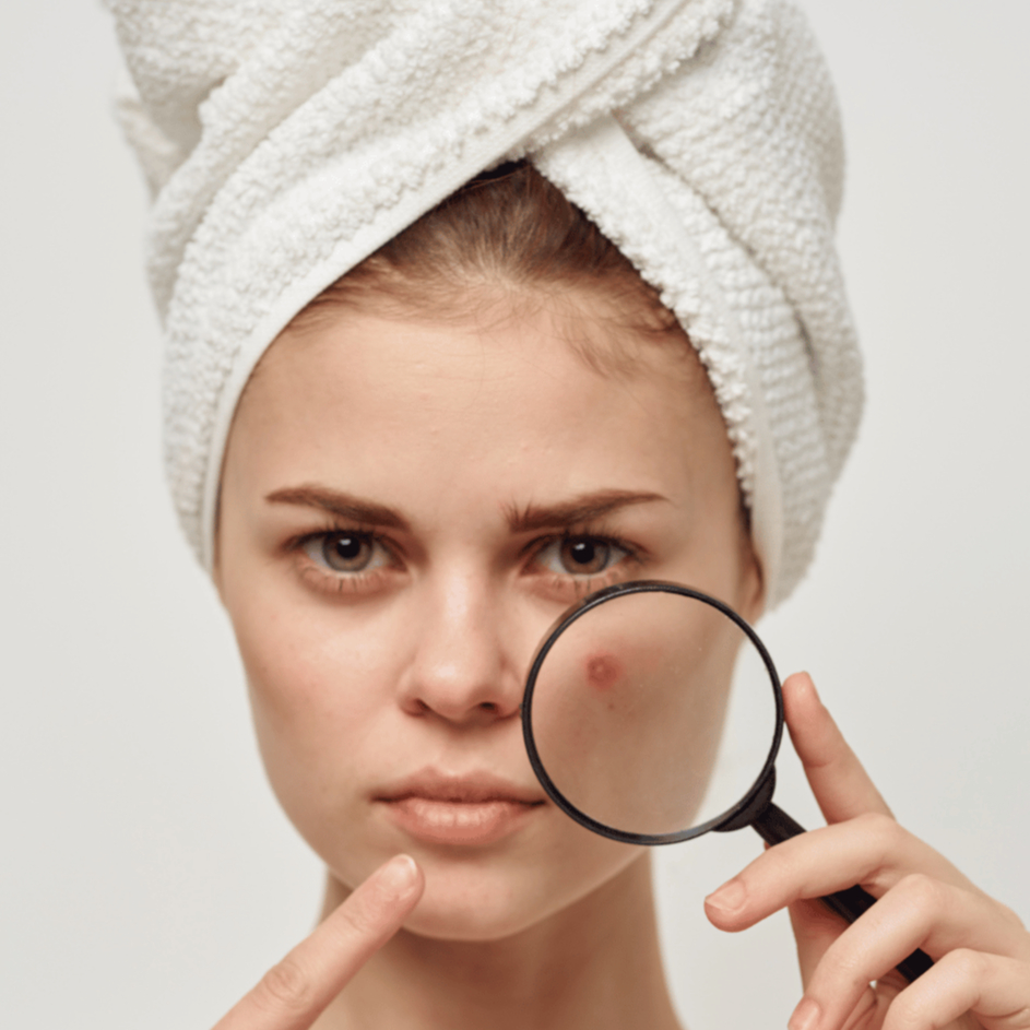 Liečba aktívneho akné