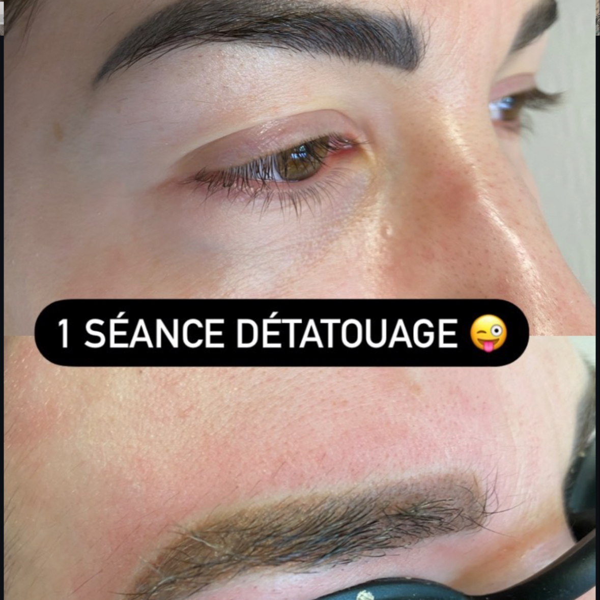 Détatouage maquillage semi-permanent