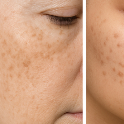 IPL mancas :lentigos solares ,melasma ,hormonales , hiperpigme