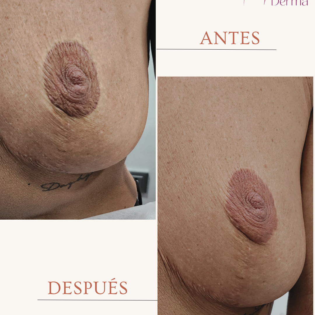 Cicatrices Areola