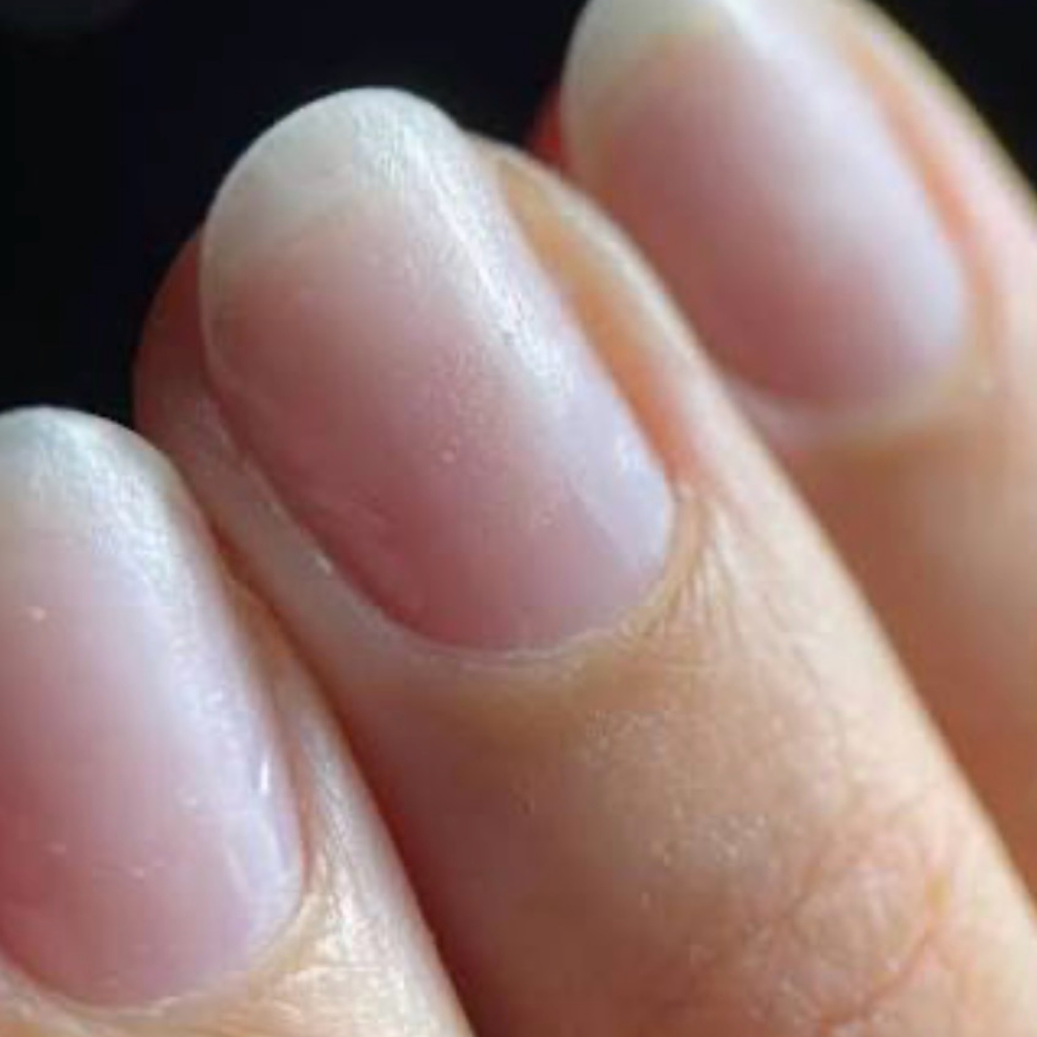 Dépose sans pose à la suite + soins