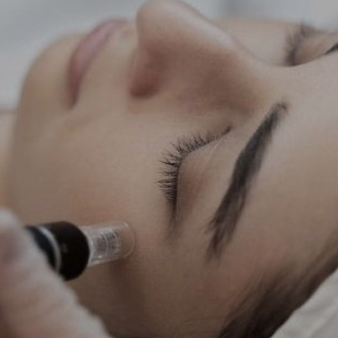Microneedling