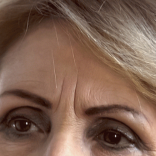 Vrásky na čele a medzi obočím