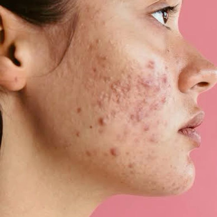 Ošeření MLADISTVÉ pleti ✤ (12-18 let)