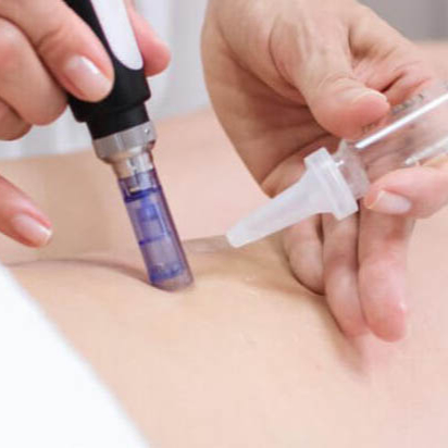 Dermapen Corporal anticelulitico