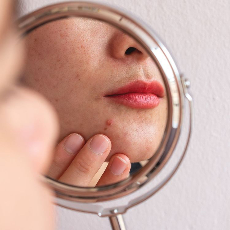 Ošetření pleti ke sklonu k akné - obličej