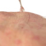 Plasma (pigment vlekken of wratten)