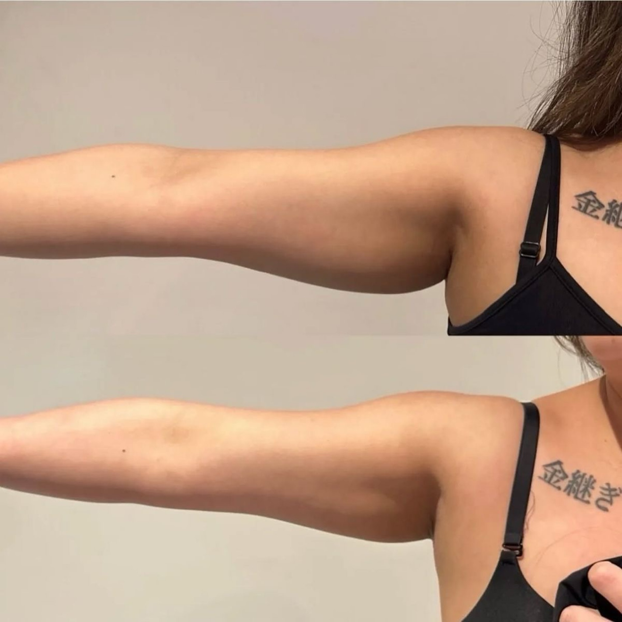 Mesolipo Terapie+VelaShape Liposukce - Paže