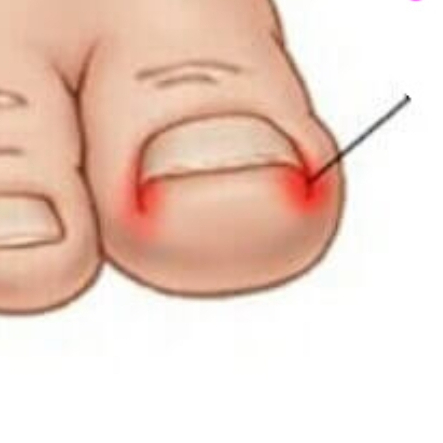 Ošetření zarostlého nehtu