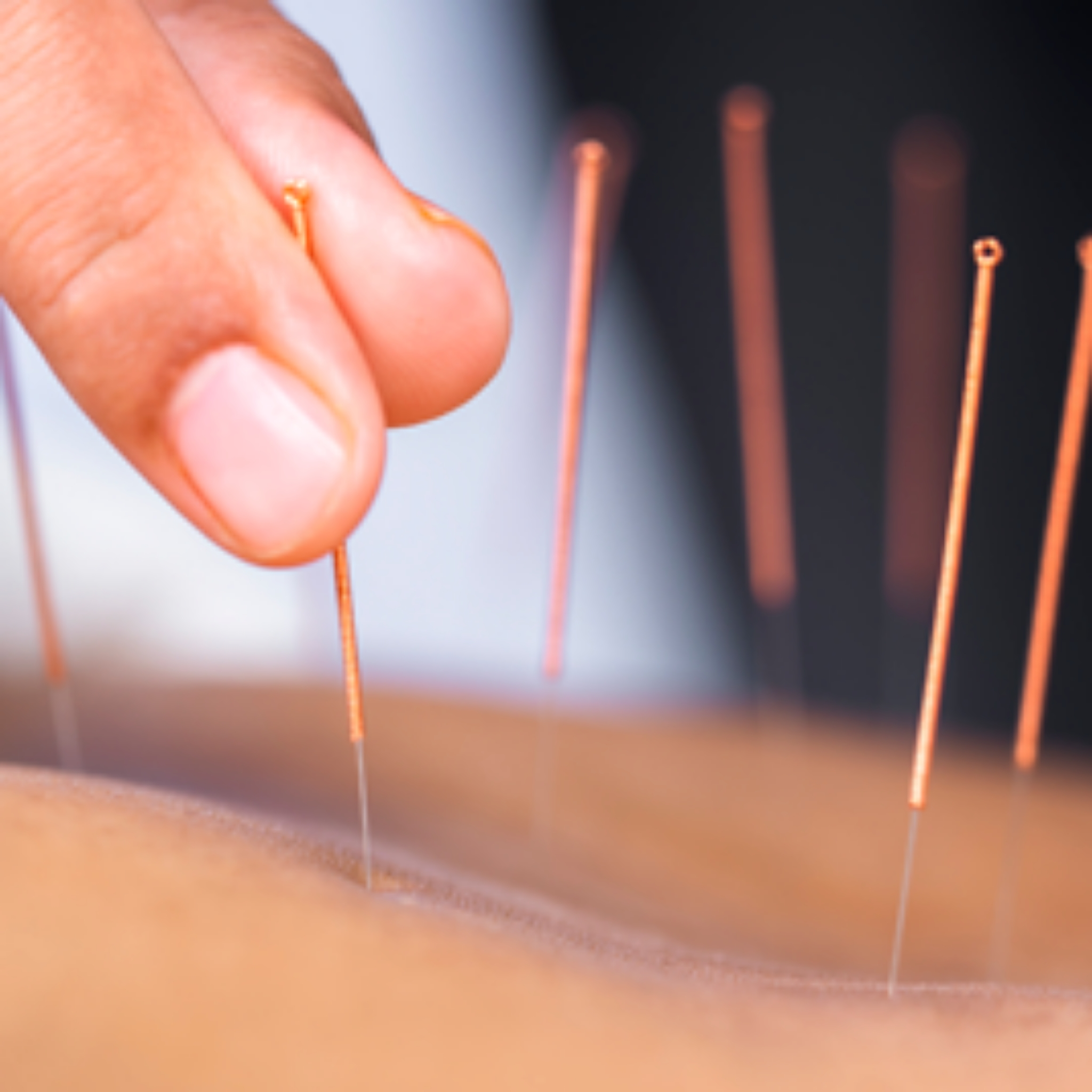 Acupuntura