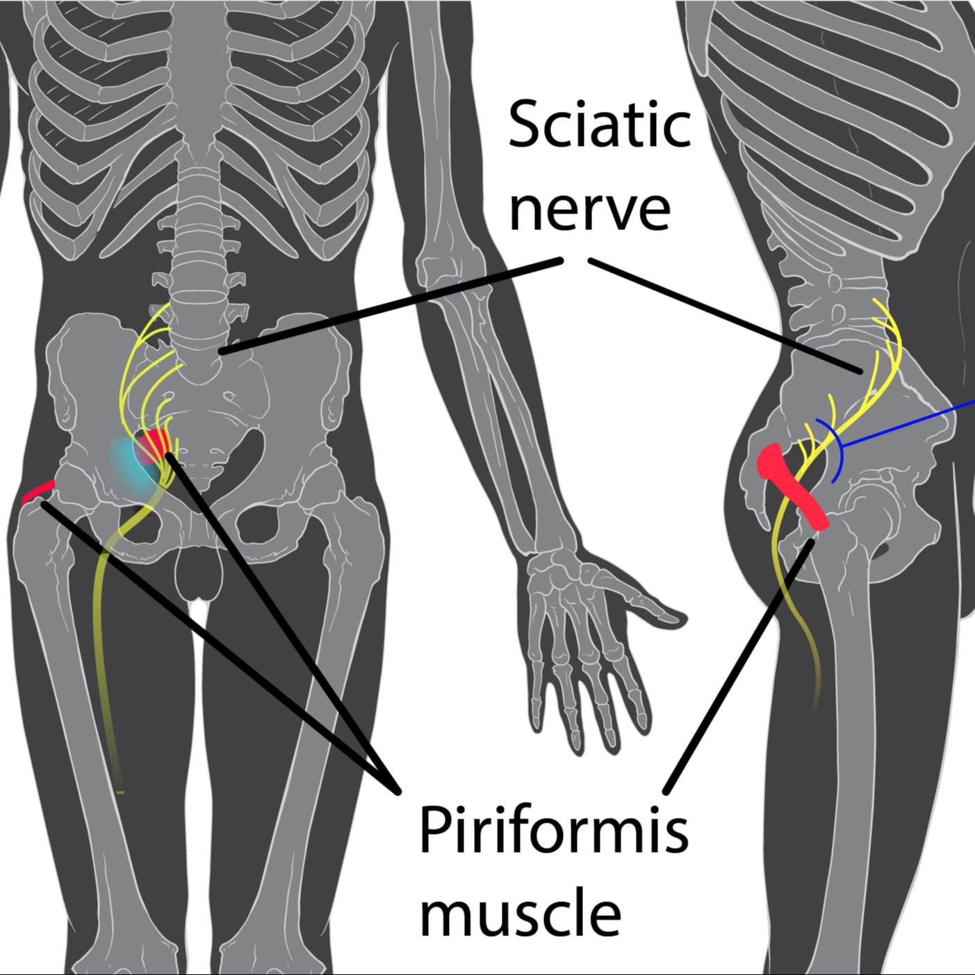 Piriformis szindróma (Ülőideg fájdalom) kezelés