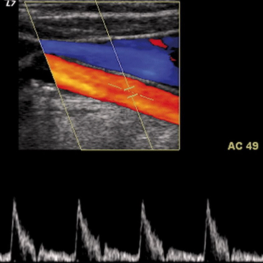 Ecocolordoppler tronchi epiaortici