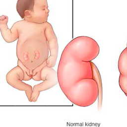 Reni e Vie urinarie neonatali (0-3 anni)
