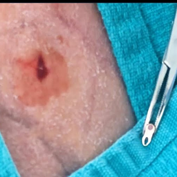 Dermal Anchor - Service d'extraction